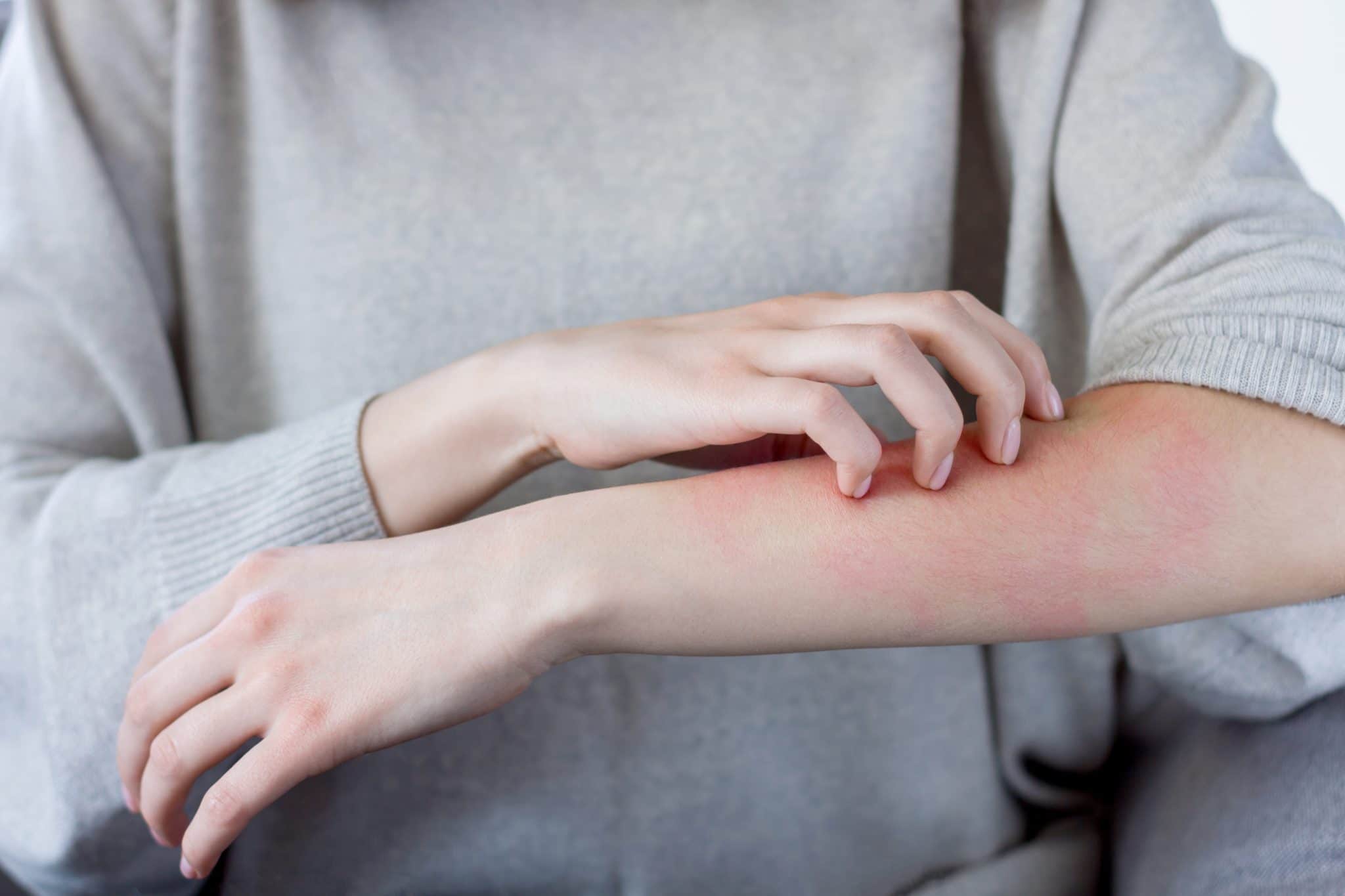 Woman dealing with rash and severe allergies.